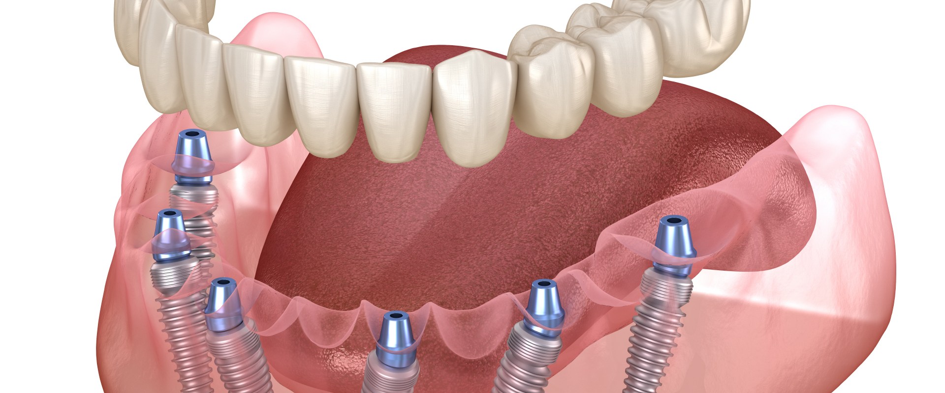 Materials Used In Dentures A Comprehensive Guide   3d26b32d50966eb4149d856e8e26ee20 