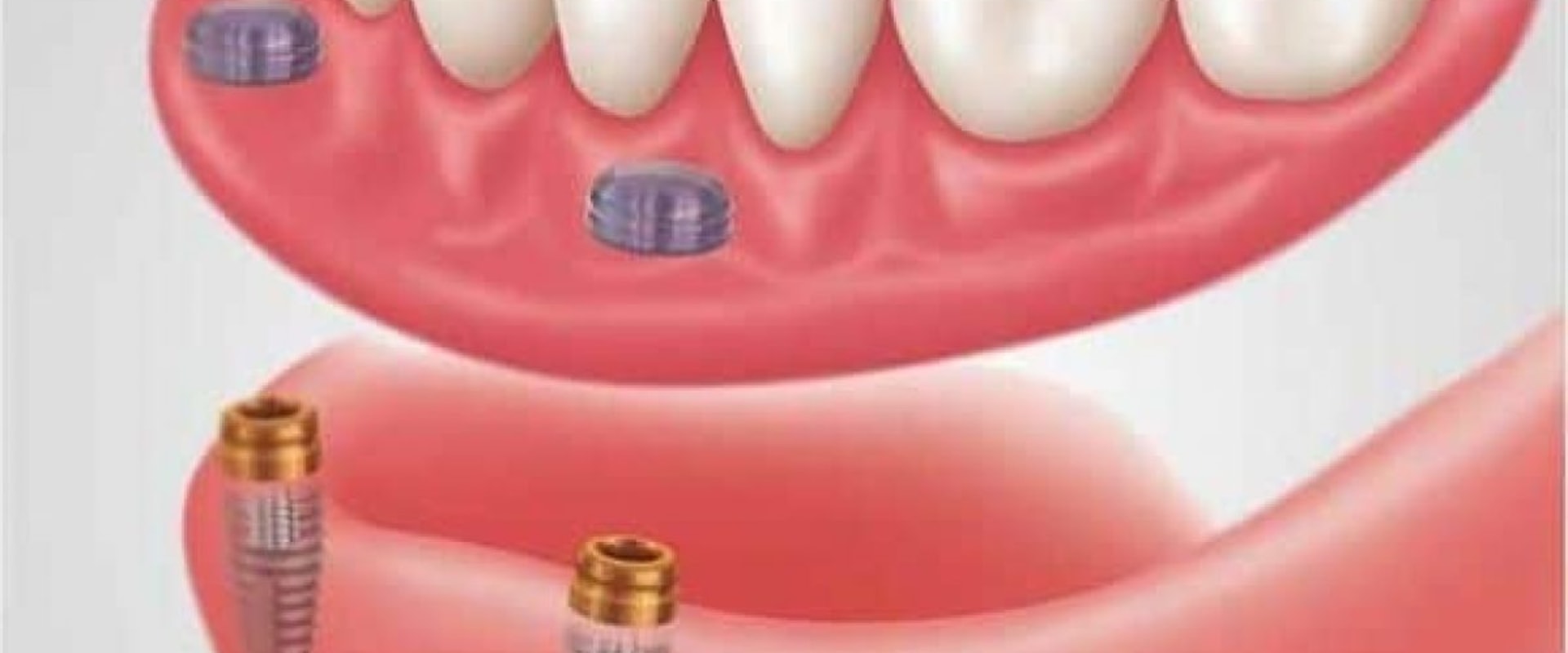 Understanding Snap On Dentures A Comprehensive Guide