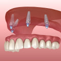 Understanding Implant-Supported Dentures