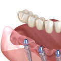 Materials Used in Dentures: A Comprehensive Guide
