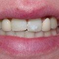 Understanding Maryland Bridges for a Perfect Smile