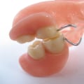 Discover the Affordability of Low-Cost Dentures