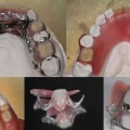 Exploring Metal Framework Partial Dentures: Everything You Need to Know