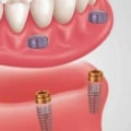 The Pros and Cons of Snap-On Dentures: A Comprehensive Comparison to Traditional Dentures