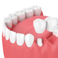 Understanding Cantilever Bridges for Your Dental Health