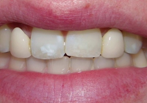 Understanding Maryland Bridges for a Perfect Smile