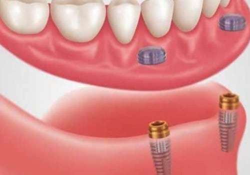 Understanding Snap-On Dentures: A Comprehensive Guide