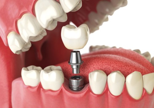 Single Tooth Implants: A Comprehensive Guide to Alternatives to Traditional Dentures and Dental Implants