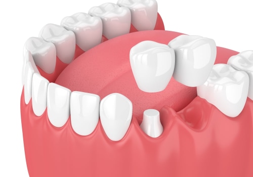 Understanding Cantilever Bridges for Your Dental Health